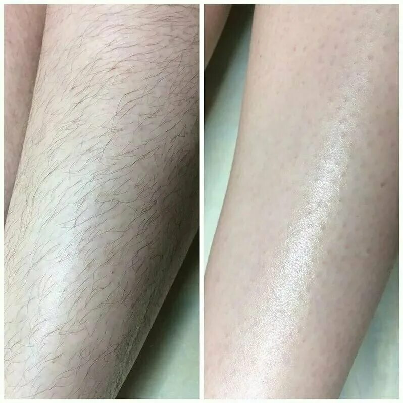 Шугаринг до и после. Депиляция. Элос эпиляция глубокое бикини. Шугаринг глубокое бикини до и после. Шугаринг ног.