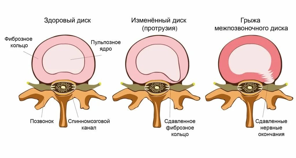 Межпозвонковая грыжа поясничного отдела лечение. Протрузия грыжа межпозвонковых дисков. Позвоночник - протрузия и грыжа диска. Пульпозное ядро и фиброзное кольцо. Грыжа позвоночника фиброзное кольцо.