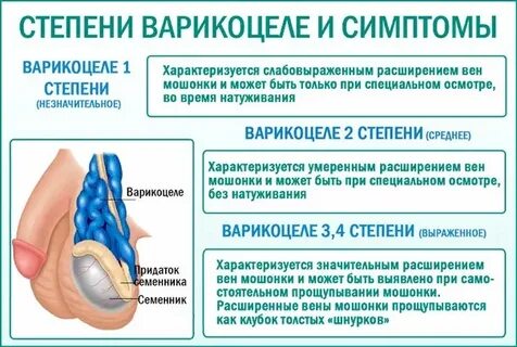 Варикоцеле 2 степени
