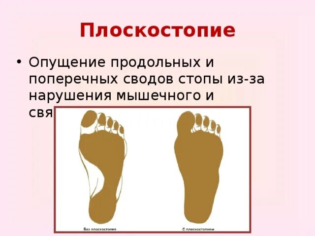 Опущение сводов стопы. Скелет стопы плоскостопие. продольно-поперечное плоскостопие. продольное и поперечное плоскостопие. плоскостопие поперечного свода стопы.