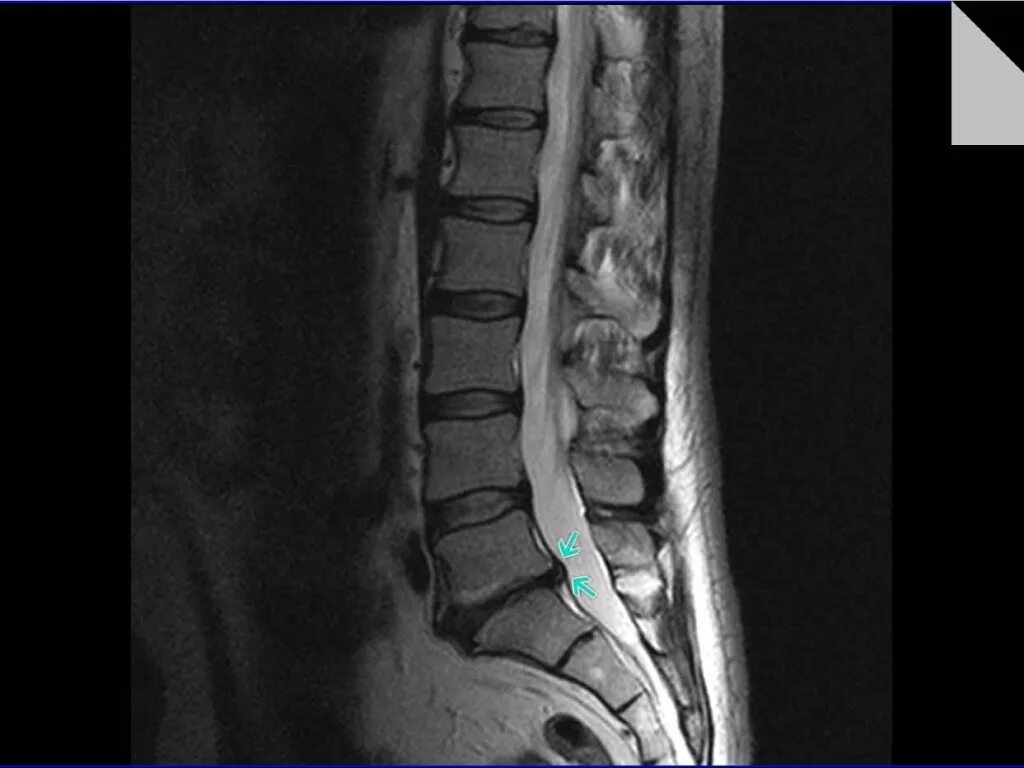 Шейный отдел позвоночника c5-c6. Протрузии с5 6 дисков шейного отдела. Протрузия диска с3 с4 шейного отдела позвоночника. Межпозвонковые диски c5 c6 c7. Межпозвонковые диски c5 c6 c7.