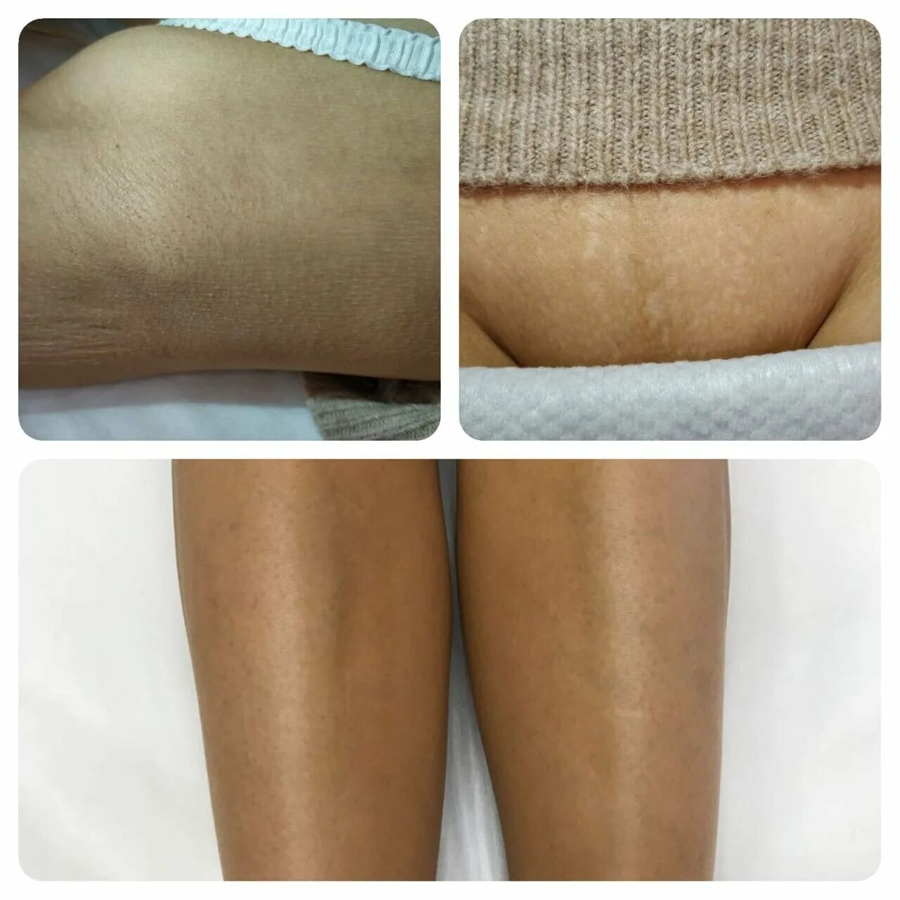 Лазерная эпиляция балашиха. Лазерная эпиляция балашиха. Эпиляция лазером. Лазерная эпиляция балашиха. Диодная лазерная эпиляция.