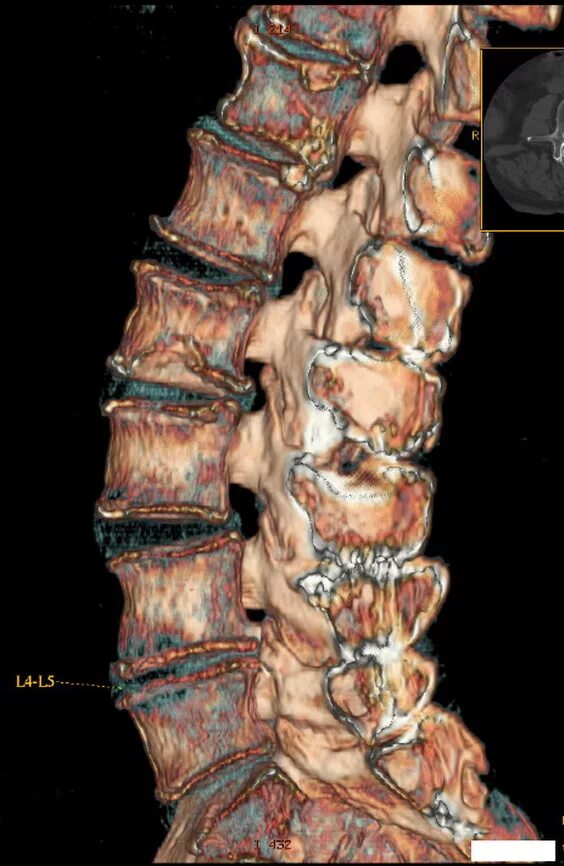 Кт пояснично-крестцового отдела позвоночника. Мрт пояснично-крестцового отдела позвоночника. Остеофиты позвоночника на кт. Кт грудо поясничного отдела позвоночника.