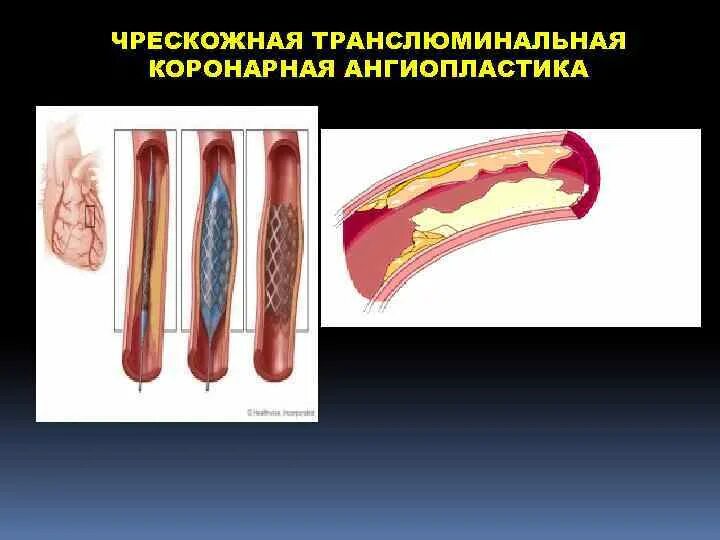 Баллонная коронарная ангиопластика. ТРАНСЛЮМИНАЛЬНАЯ коронарная ангиопластика. ТРАНСЛЮМИНАЛЬНАЯ баллонная ангиопластика коронарных артерий. ТРАНСЛЮМИНАЛЬНАЯ баллонная ангиопластика почечной артерии. Транслюмбальная аортопластика коронарных артерий.