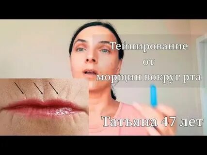Тейпирование кисетных морщин