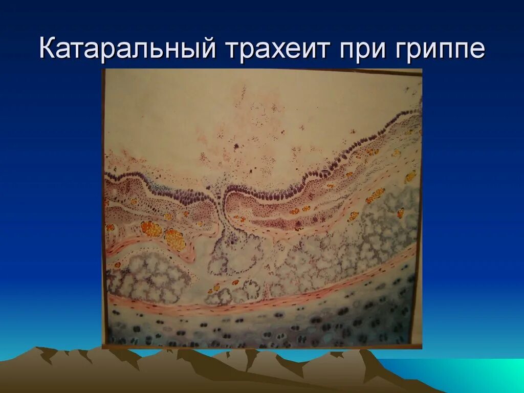 Крупозный бронхит микропрепарат. Геморрагическая пневмония при гриппе макропрепарат. Фибринозный трахеит патанатомия. Хронический бронхит патанатомия классификация. Гриппозная геморрагическая пневмония микропрепарат.