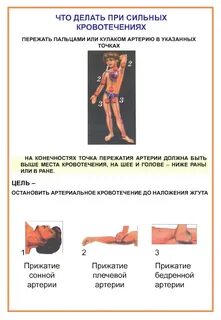 Пережала артерию