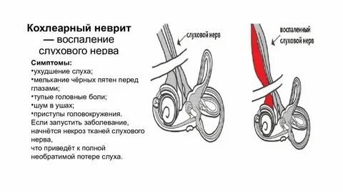 Чем лечить слуховой нерв