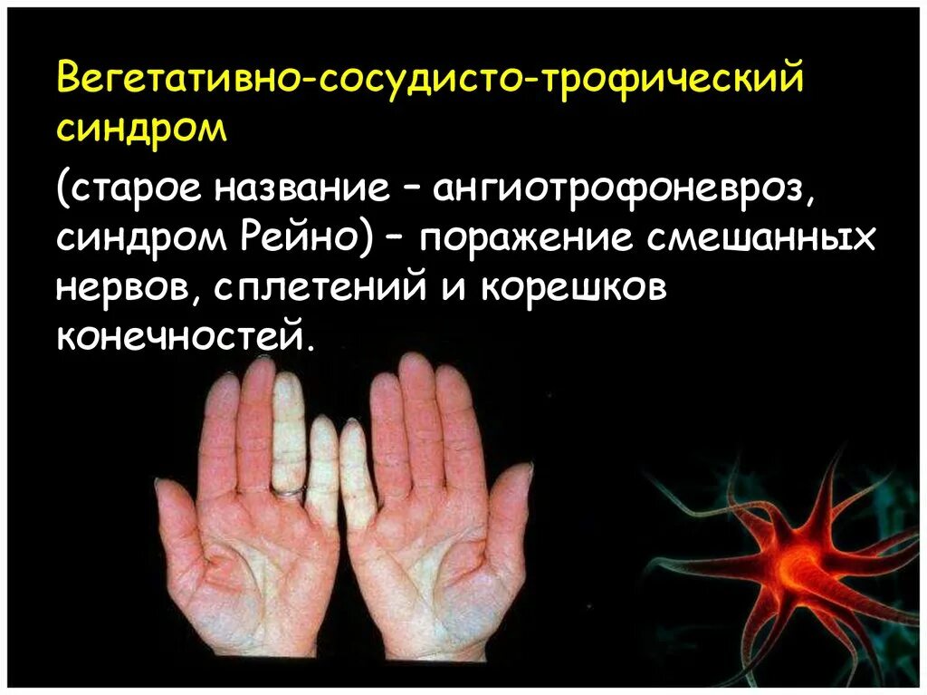 Синдром рейно это простыми словами. Ангиотрофоневрозы. Болезнь Рейно.. Вегетативно трофический синдром. Вегетативно-сосудисто-трофический синдром.