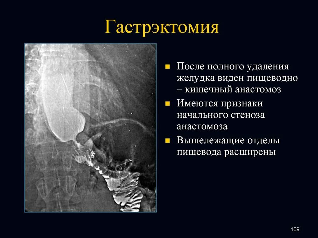 Операция гастрэктомия. Операция гастроэктомия желудка. Желудок после резекции. Полное удаление желудка