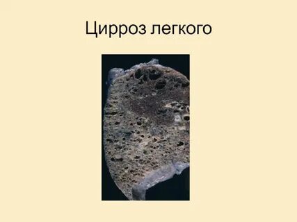 Цирроз легкого