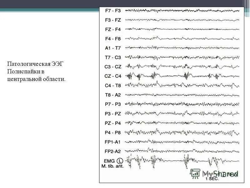 Исследование головного мозга ЭЭГ. Расшифровка электроэнцефалограммы головного мозга норма. Нормальная диаграмма ЭЭГ. Патологическая активность на ЭЭГ что это.