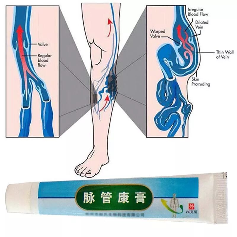 Флебит мазь. Варикозное расширение вен нижних конечностей препараты. Варикозное расширение вен нижних конечностей таблетки. Сосудистые варикозные расширения вен.