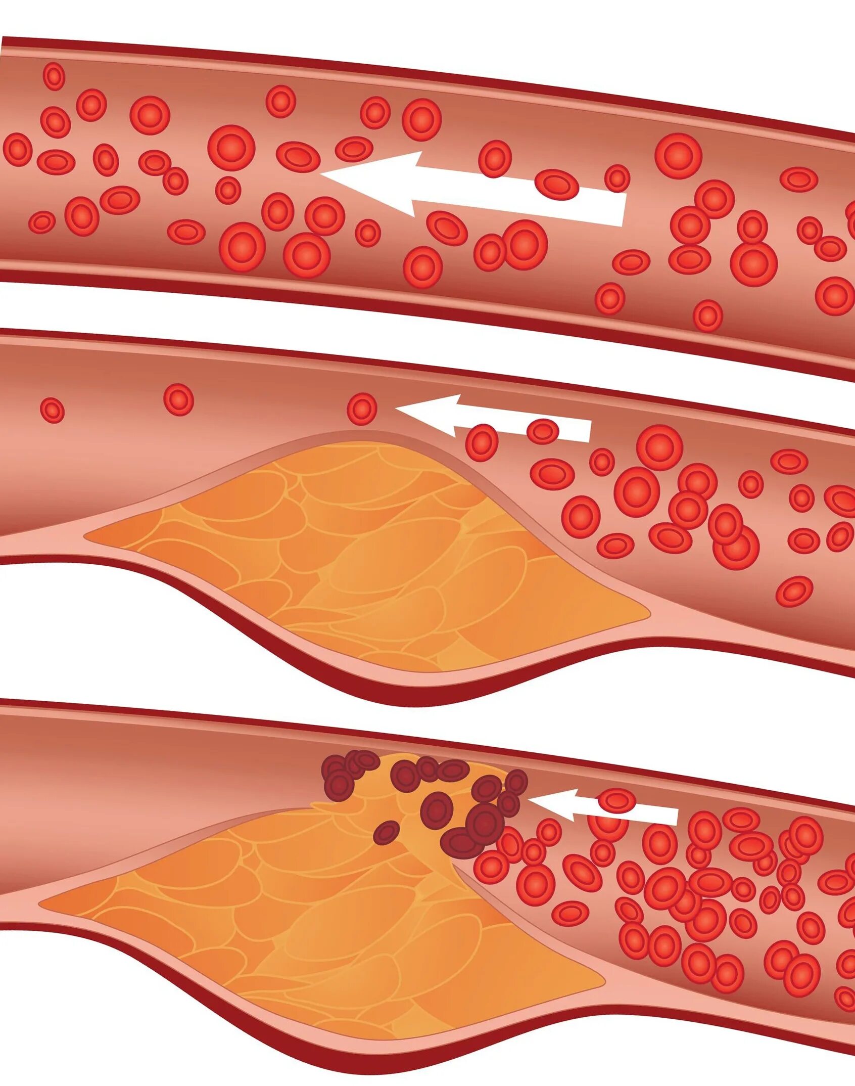 Разрыв кровеносного сосуда. Атеросклеротические бляшки патология. Атеросклероз бляшки сосудов. Атеросклероз пенильных артерий.