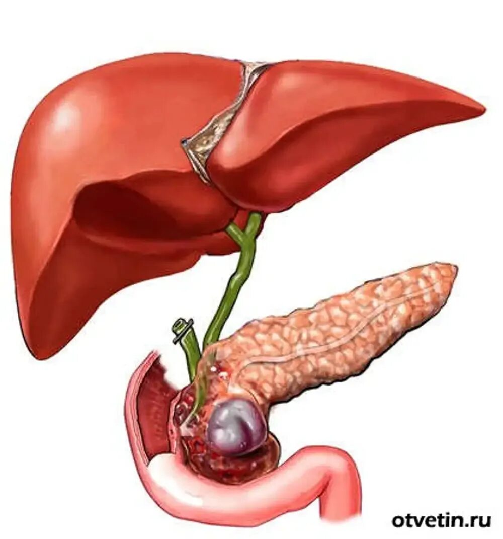 Холецистит причины заболевания. Калькулезный холецистит. Холецистит анатомия желчного пузыря. Желчнокаменная болезнь анатомия. ЖКБ камни желчного пузыря.