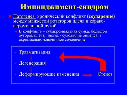Субакромиальный импинджмент синдром плечевого сустава