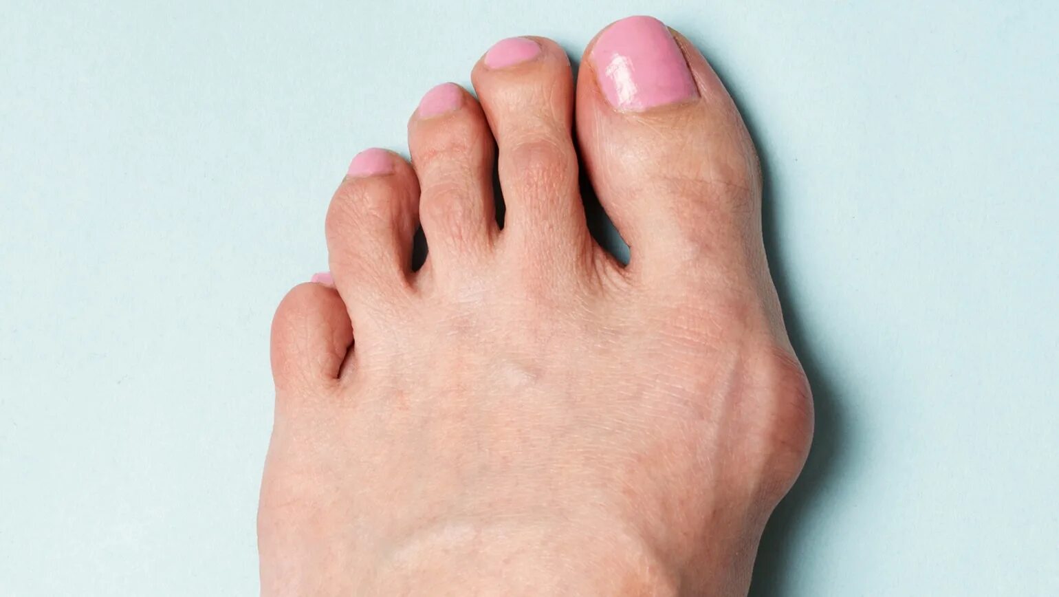 Очень сильно болит палец. Вальгусная деформация большого пальца стопы( hallux valgus. Выступающая косточка на ноге.