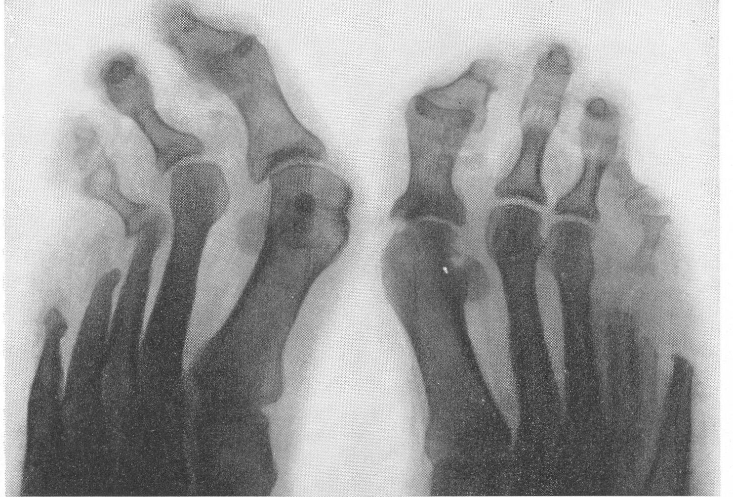 Заболевания скелета (туберкулез, опухоли костей, остеомиелит). Туберкулез костей рентгенологическая картина. Фунгозный костно суставной туберкулез. Туберкулез суставов рентген.