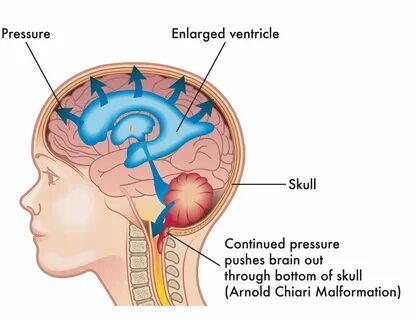 Chiari Malformation and Syringomyelia: What You Should Know - The Spine Pra...
