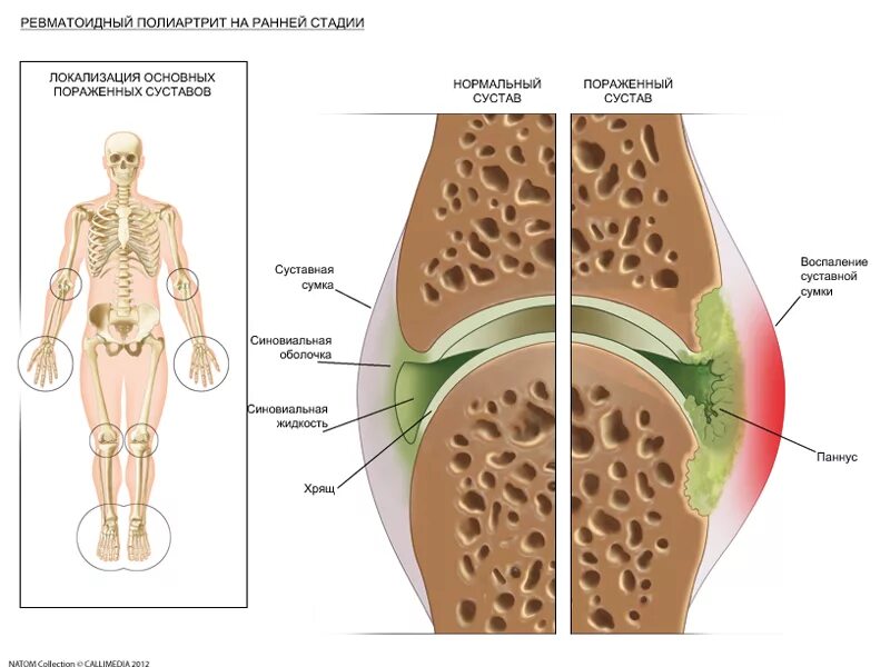 Ранняя стадия ревматоидного артрита. Ревматоидный артрит поражение суставов. Ревматоидный полиартрит. Ревматоидный полиартрит стадии. Стадии поражения суставов.