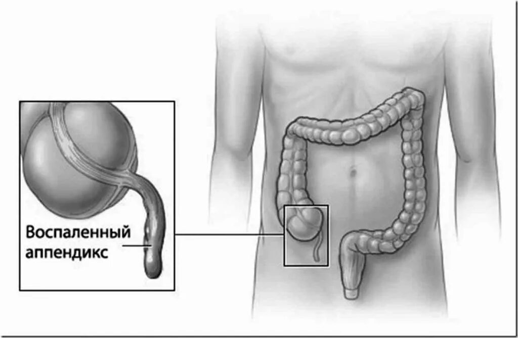Воспаленный аппендикс. Аппендикс где находится и как болит
