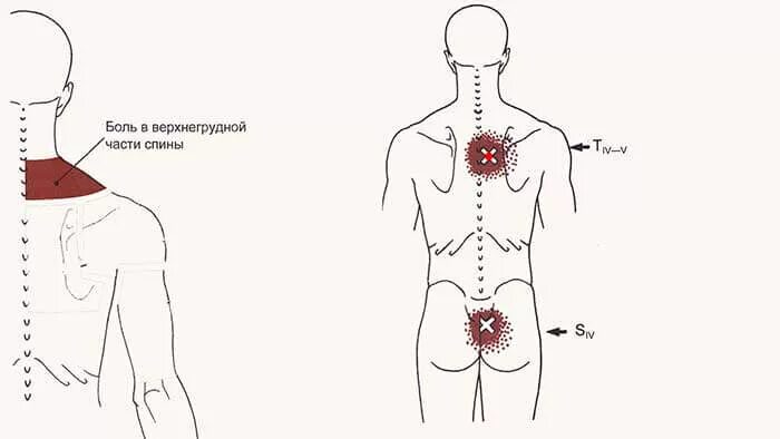 Сильно болит верхний. Триггерные точки на спине схема. Болевые триггерные точки схема. Триггерные точки спины поясница. Триггерные точки верхняя часть спины.