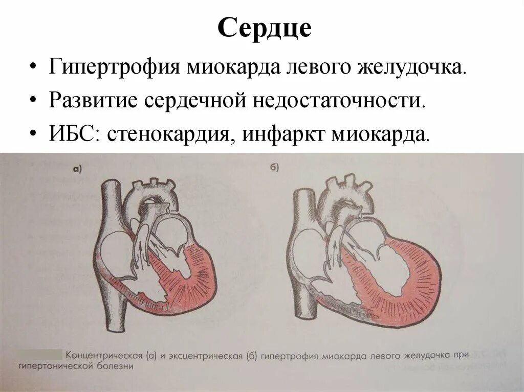 Миокард правого желудочка сердца. Эксцентрическая гипертрофия лж. Эксцентрическая гипертрофия сердца. Концентрическая гипертрофия миокарда. Гипертрофия миокарда левого желудочка сердца что это такое.