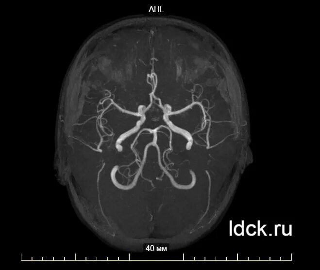 Магнитно-резонансная ангиография сосудов головного мозга. МРА артерий головного мозга. Мрт ангиограмма сосудов головного мозга. Кт ангиография сосудов головного мозга.
