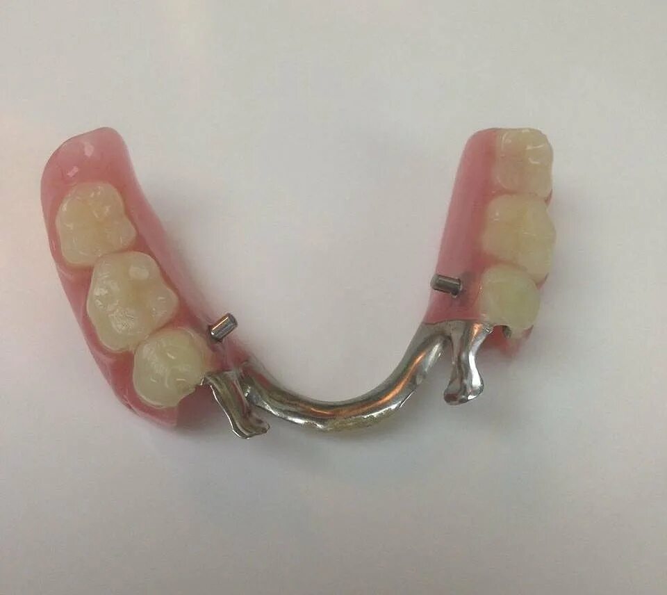 бюгильныйпротез нижнейчелюсти. бюгельный протез а16. 036. бюгельный протез (1 челюсть)+кламмер. шинирующий бюгельный протез.
