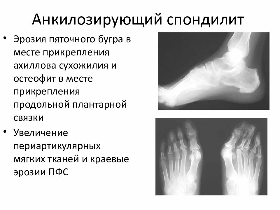 Болезнь бехтерева анкилозирующий. Анкилозирующий спондилит болезнь бехтерева. анкилозирующий артрит. м45 анкилозирующий спондилит. анкилозирующий спондилит рентген кисти.