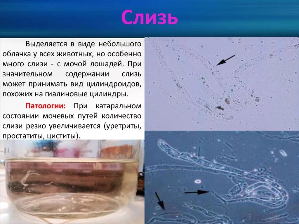 Вытекает моча почему. Слизь в моче. Слизь в моче осадки. Слизь в осадке мочи. Слизь в моче у ребенка.