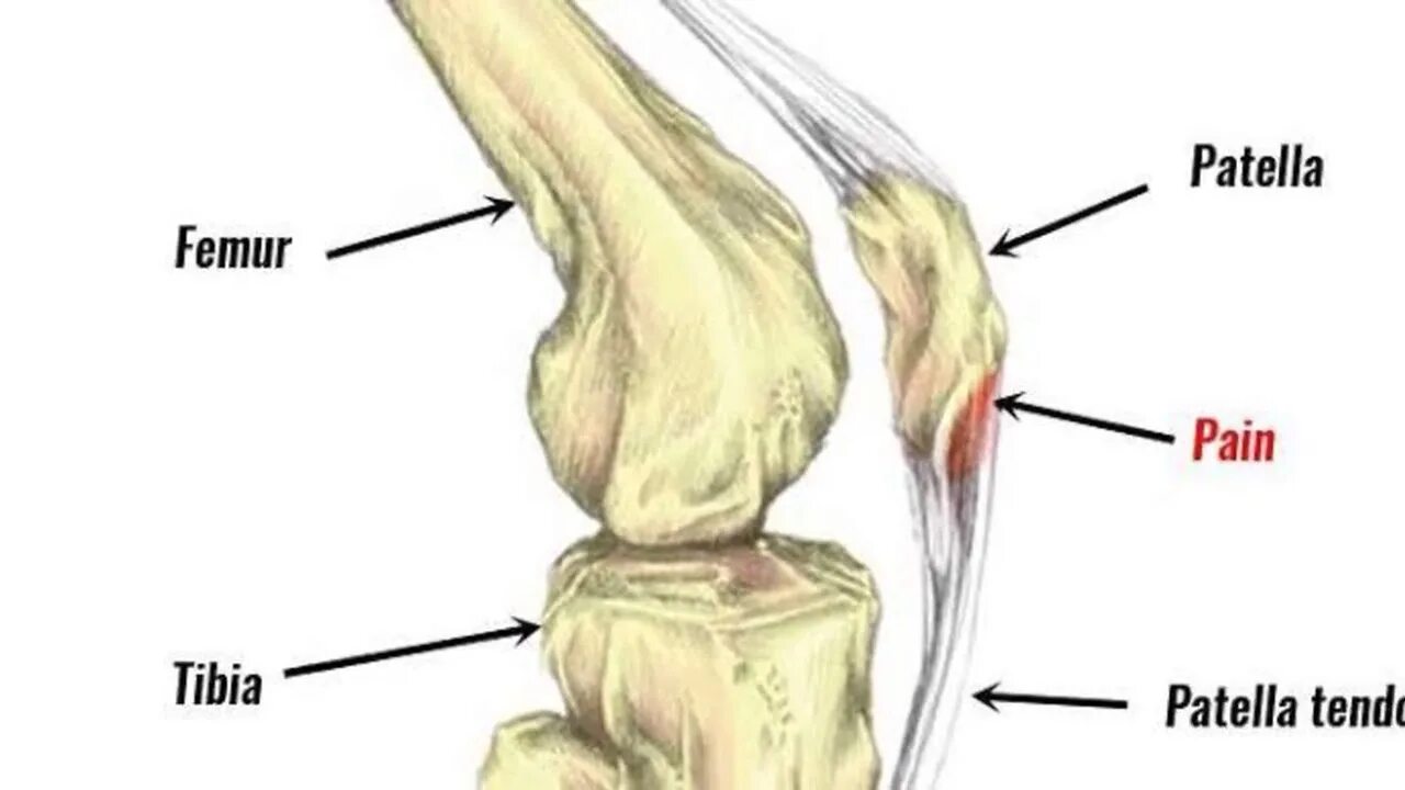 Колено прыгуна тендинит надколенника. Тендинит сухожилия надколенника. Тендинит сухожилия собственной связки надколенника. Надколенник Patella.