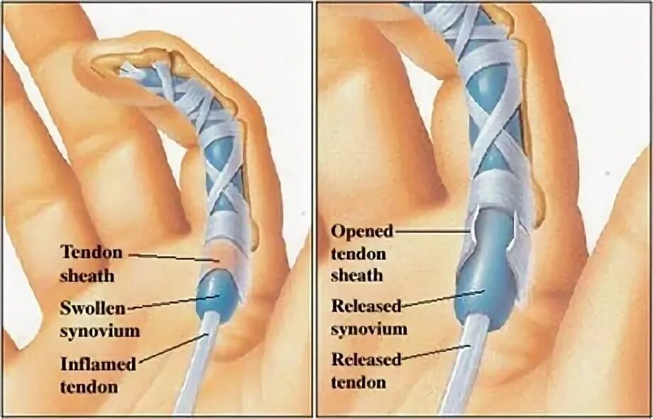 Стенозирующий лигаментит. Болезнь Нотта. Лигаментит пальцев кисти. Болезнь Нотта щелкающий палец. Кольцевидная связка 1 пальца кисти. Операция на большом пальце руки