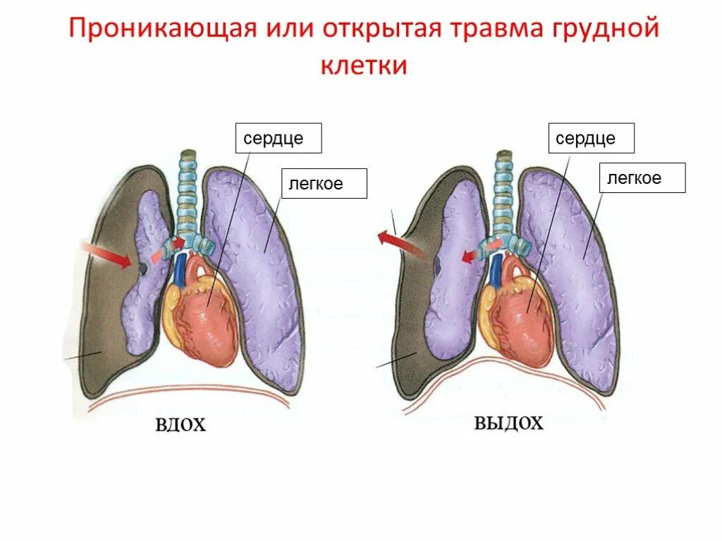 Первая помощь при повреждении грудной клетки. Проникающие травмы грудной клетки. При проникающих ранениях груди:. Повреждения и травмы грудной клетки. Первая медицинская помощь при проникающем ранении грудной клетки.