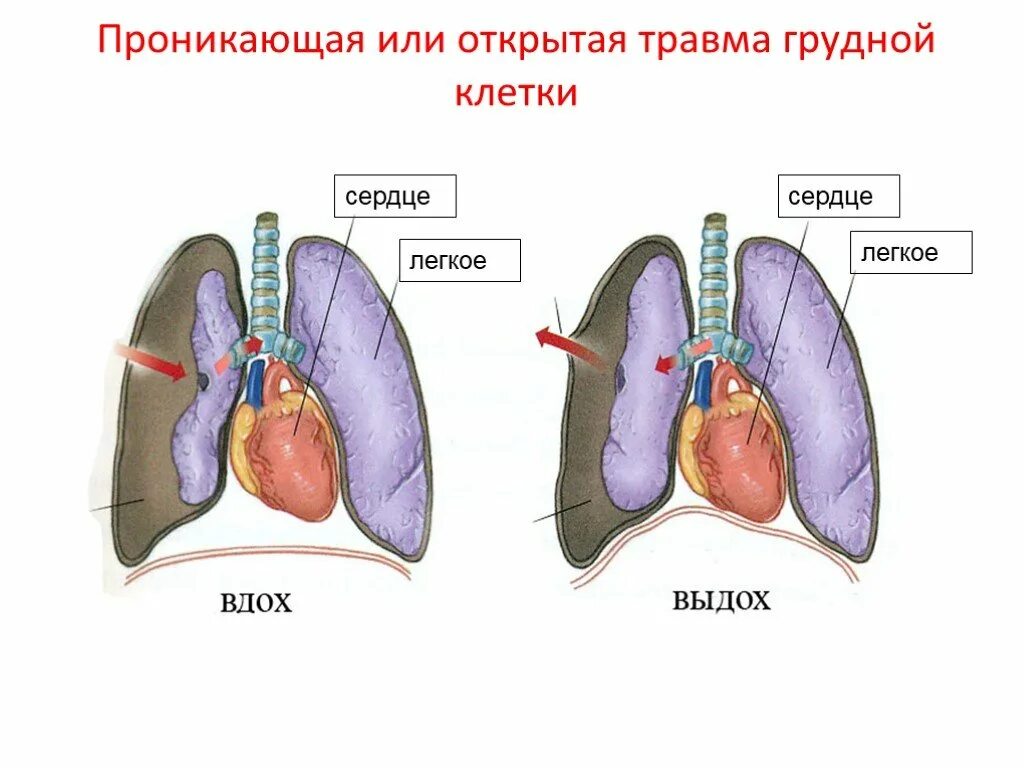 Признаки повреждения легких. Пневмоторакс разрыв легкого. Ранение в грудную клетку пневмоторакс. Травма грудной клетки пневмоторакс симптомы.