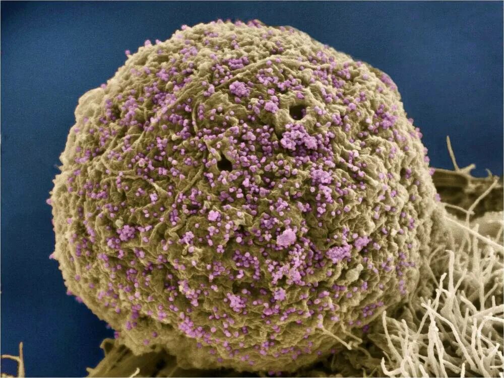 ВИЧ И СПИД под микроскопом. Вирусы под микроскопом. Вирус ВИЧ под микроскопом. Вирус в микроскопе. Human immunodeficiency