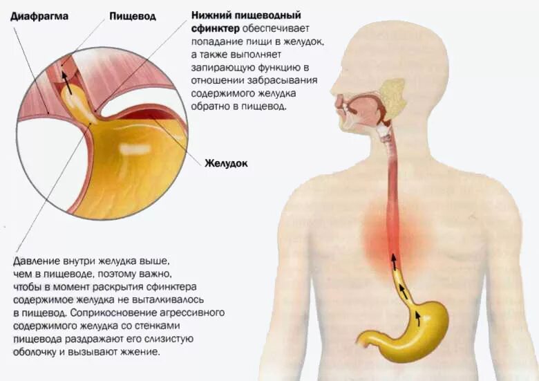 Гиперчувствительный пищевод