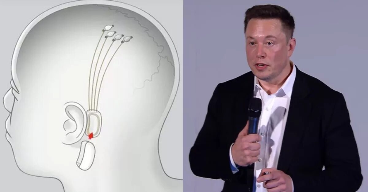 Илон маск имплант. Neurolink Элон Маск.