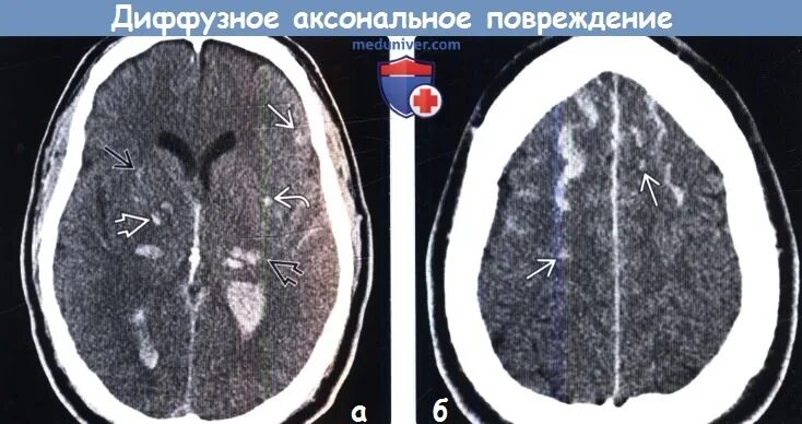 Аксональное повреждение головного. Диффузное аксональное повреждение кт. Диффузное аксональное повреждение головного мозга. Аксональное повреждение головного мозга на кт. Диффузное аксональное повреждение головного мозга кт.