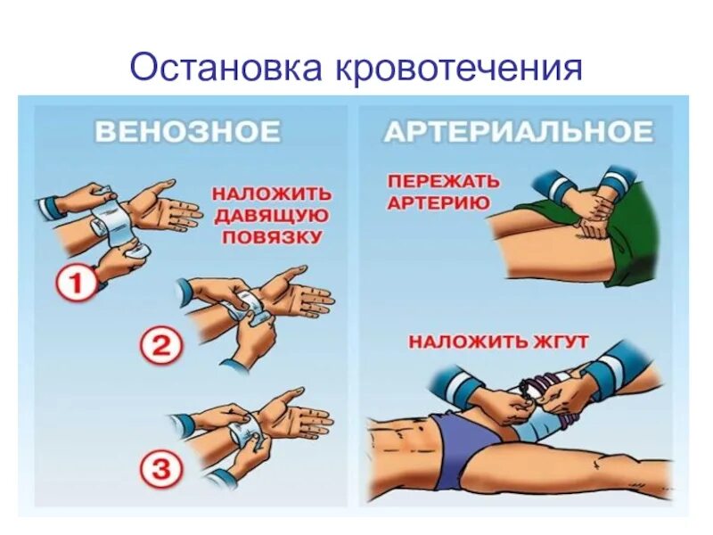 Как остановить сильную кровь. Остановка кровотечения. Остановкакровотеечния. Способы остановки кровотечения. Остановка венозного кровотечения.