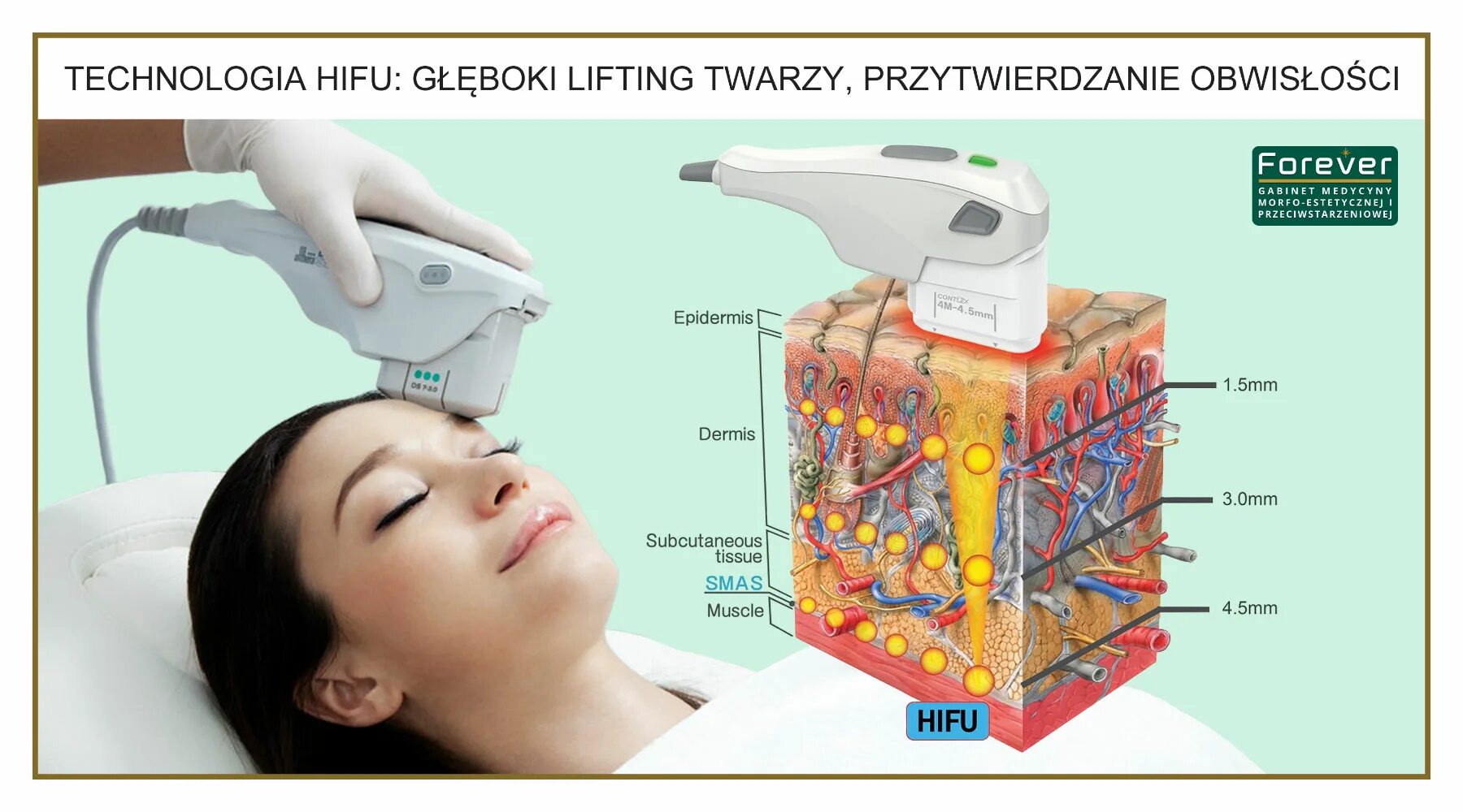 Smas лифтинг skinlift. Аппарат HIFU 3d. Аппарат HIFU Ultrasound 4d. Аппарат смас лифтинг HIFU. HIFU 7d аппарат.