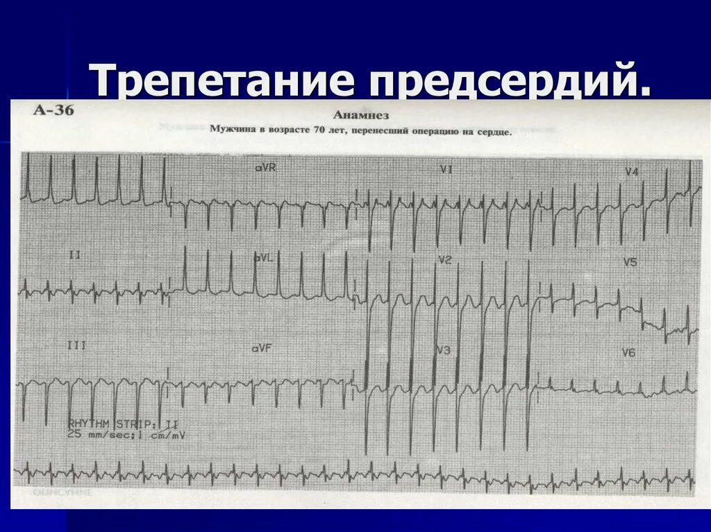 Тахисистолия это. ЭКГ типичное трепетание предсердий 2:1. Трепетание предсердий 2 к 1 на ЭКГ. Трепетание предсердий ритмированная форма 2 1. Правильная форма фибрилляции предсердий.