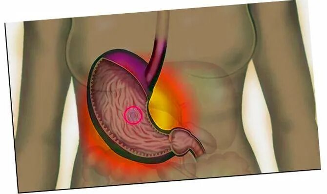 Печёт в области желудка. Печегжелудок. Сильная в области желудка