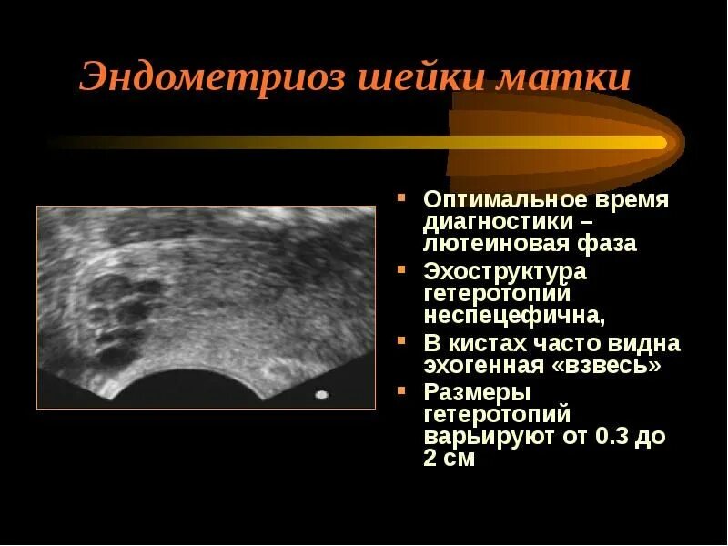 УЗИ признаки эндометриоза матки. Признаки эндометриоза тела матки на УЗИ что это. Эндометриоз матки УЗИ признаки. Эндометриоз шейки матки. Эндометриоз матки как лечить после 40 лет