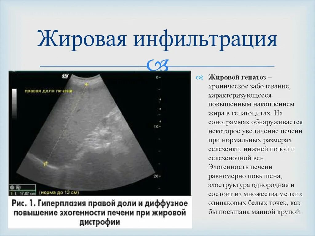 Что означает диффузные изменения печени. Жировая инфильтрация печени узи. узи печени при жировой инфильтрации. диффузный гепатоз печени что это такое.