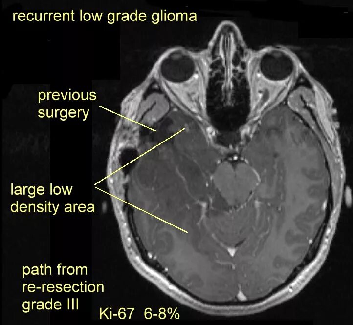 Low grade яичников. Глиома Grade 1 кт. Глиома четверохолмия мрт.