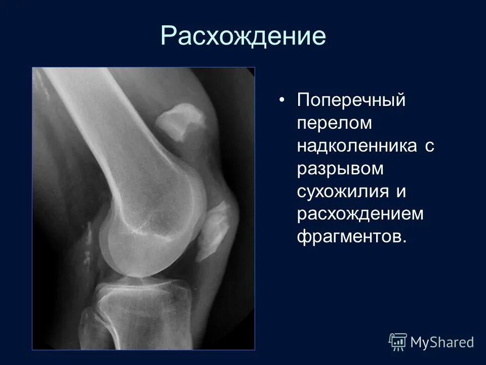 Перелом надколенника классификация ао. Перелом надколенника без смещения лечение. Рентген коленного сустава перелом надколенника. Перелом надколенника без смещения лечение. Перелом полюса надколенника.
