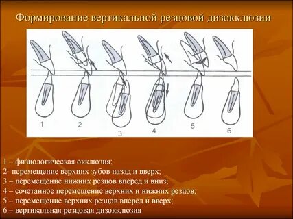 Резцовая окклюзия