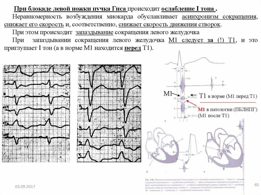 Нарушение блокады гиса. Блокада левой ножки пучка Гиса на ЭКГ. ЭКГ при блокаде левой ножки пучка Гиса. ЭКГ признаки блокады ножек пучка Гиса. Внутрижелудочковая блокада правой ножки пучка Гиса.