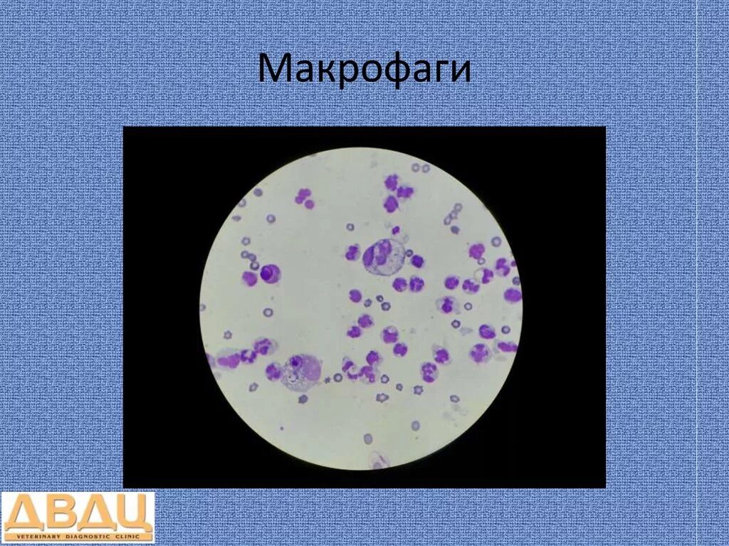 Микроскопия выпотных жидкостей. Выпотные жидкости микроскопическое исследование. Макрофаги в выпотных жидкостях. Макрофаги микроскопия. Свободные макрофаги